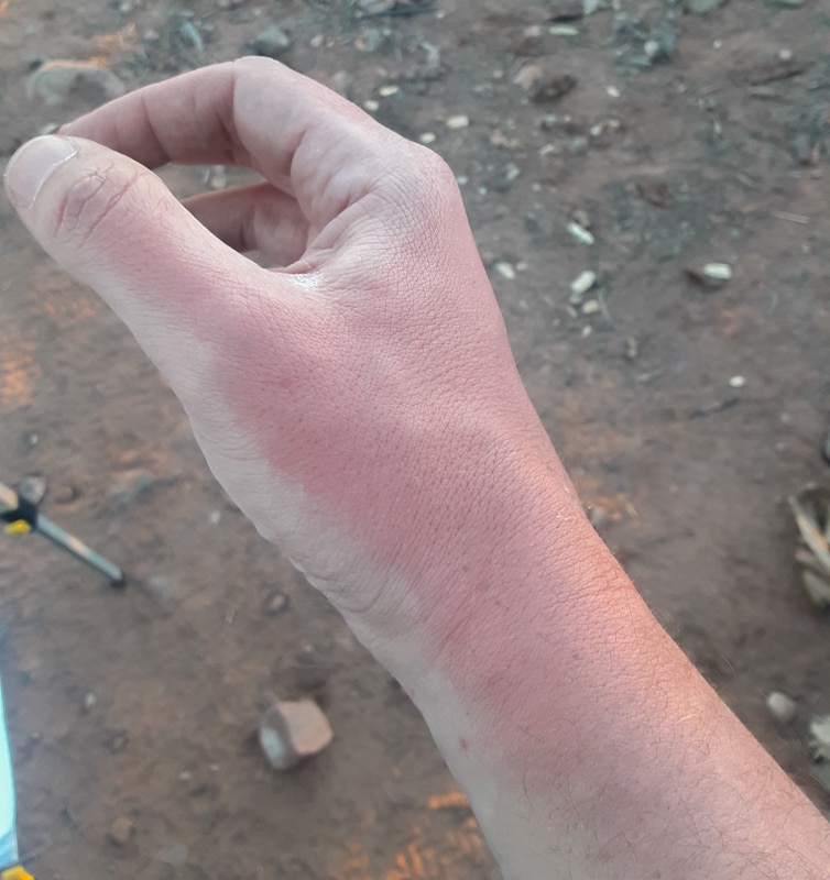 sunburnt hand